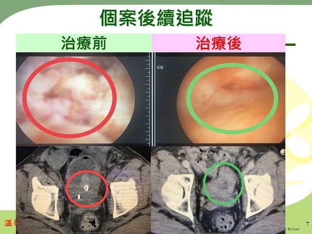 晚期抗癌新契機，提升營養儲備免疫力