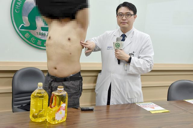 自打沙拉油成D罩杯 「3D內視鏡乳房手術」成功變回型男