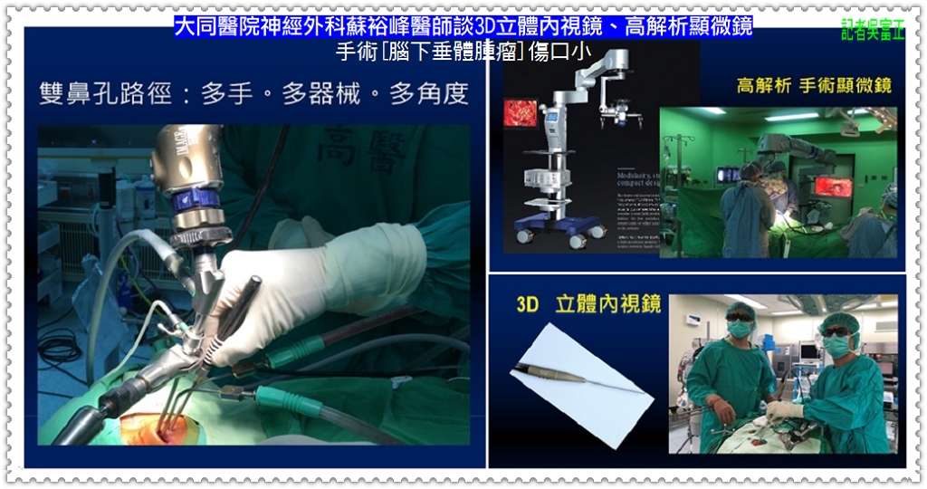 大同醫院神經外科蘇裕峰醫師談3D立體內視鏡、高解析顯微鏡手術[腦下垂體腫瘤]傷口小＠民生好報