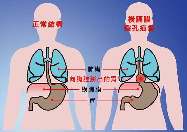 橫膈膜裂孔疝氣胃食道逆流半世紀 三術式解危