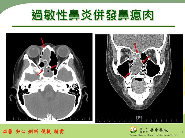 過敏鼻水流不停　當心鼻瘜肉作祟