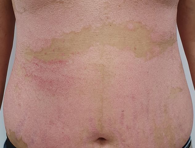 美食當前乾癬患者宜忌口　避免疾病症狀惡化