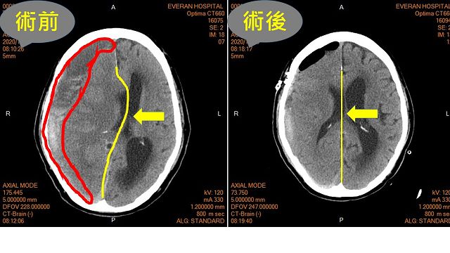 反應遲緩、偏癱？難道是腦中風？