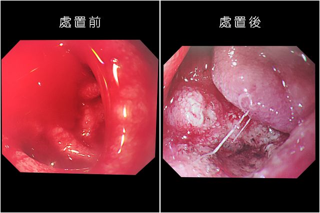 腸胃道出血病人增多　天氣急凍保「胃」戰