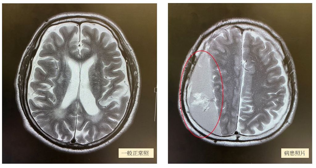 半邊身體無力竟是硬腦膜下出血惹禍