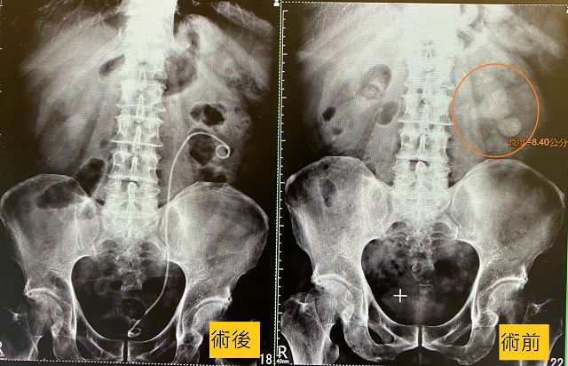 8公分腎結石　軟式輸尿管鏡碎石術一次清除乾淨