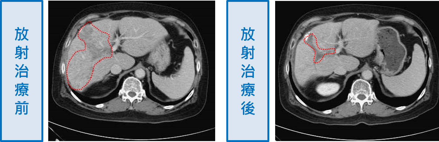 肝癌一要開刀？ 放療+標靶有效控制腫瘤